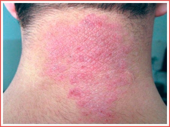 neurodermatitis