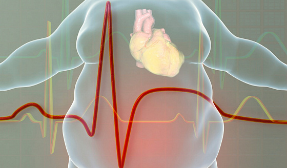 metabolic syndrome